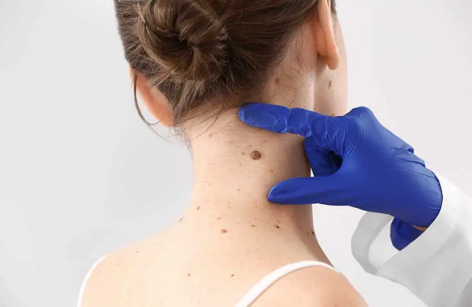 Skin Tag Removal in Memphis, TN by Skin + Ivy Wellness