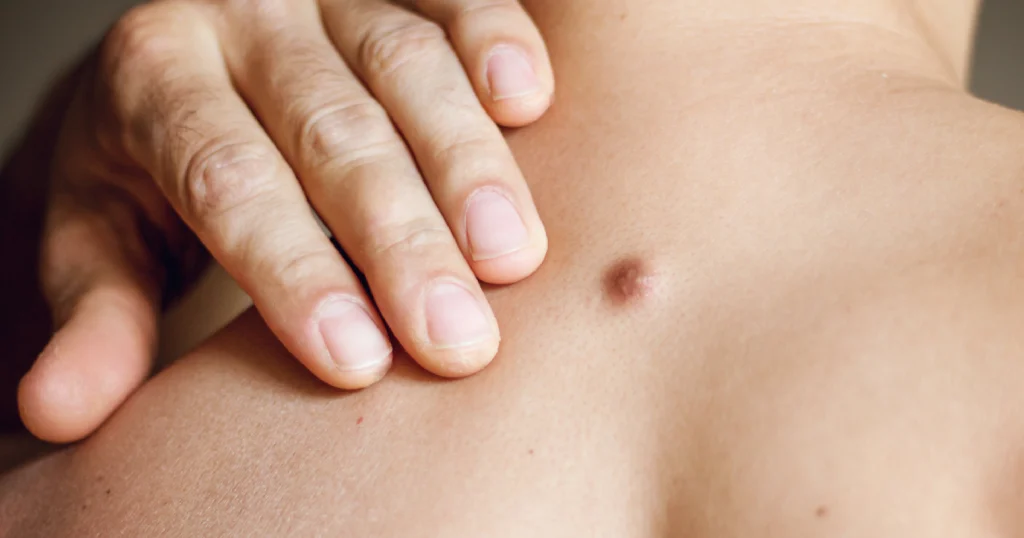 Current image: Man showing a skin tag on his back before Skin Tag Removal in Memphis, TN