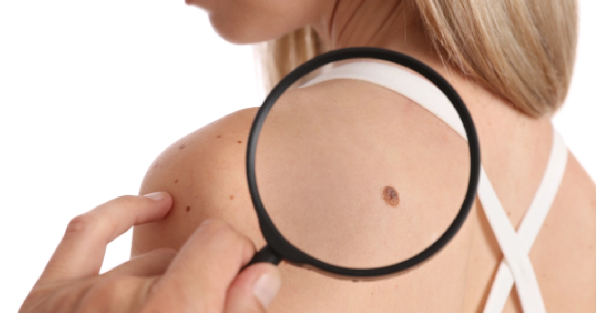 A dermatologist uses a magnifying glass to examine a mole on a woman's shoulder during Skin Tag Removal in Memphis, TN.