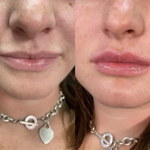 Lip Filler-before-after-skin-ivy-in-memphis-TN