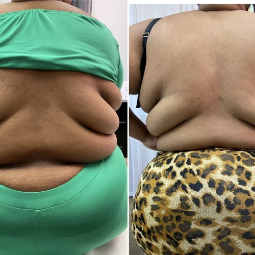 Liquid-Lipo-before-after-skin-ivy-in-memphis-TN