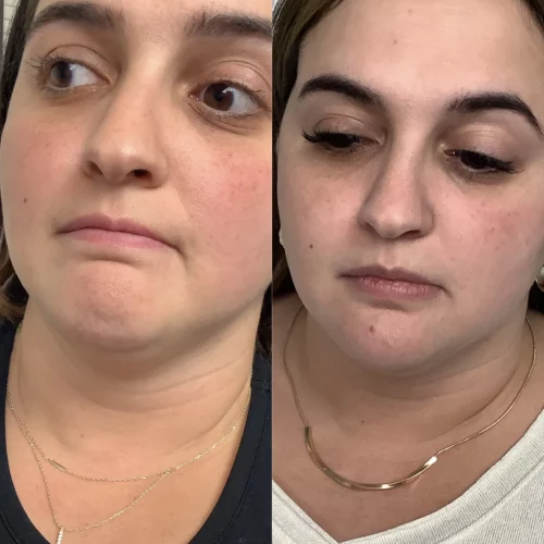 Liquid-Lipo-chin-before-after-skin-ivy-in-memphis-TN