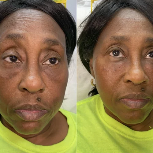 PRP-before-after-skin-ivy-in-memphis-TN