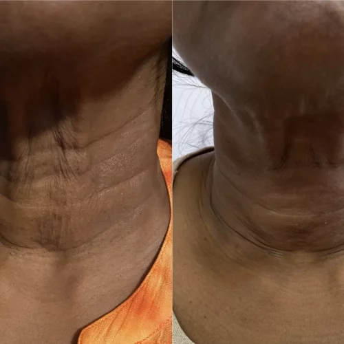 Radiesse-before-after-skin-ivy-in-memphis-TN