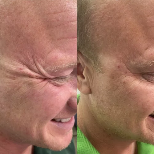 botox-before-after-skin-ivy-in-memphis-TN