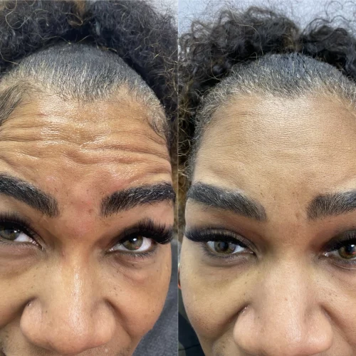 botox-two-before-after-skin-ivy-in-memphis-TN