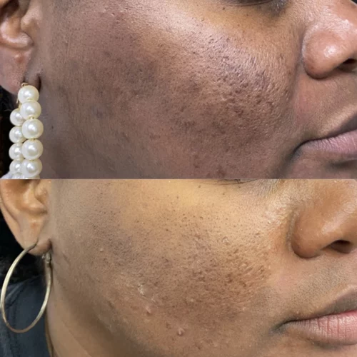 chemical-peel-before-after-skin-ivy-in-memphis-TN