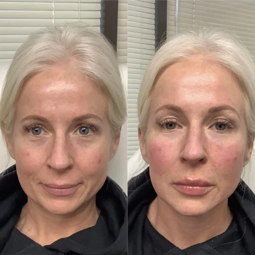 filler-chin-before-after-skin-ivy-in-memphis-TN