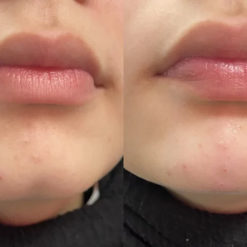 filler-dimple-chin-before-after-skin-ivy-in-memphis-TN