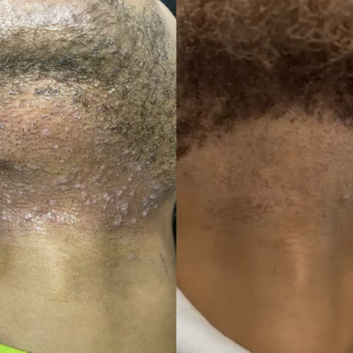 laser-hair-removal-before-after-skin-ivy-in-memphis-TN